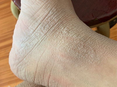 窩狀角質松解症腳部皮膚粗糙圖