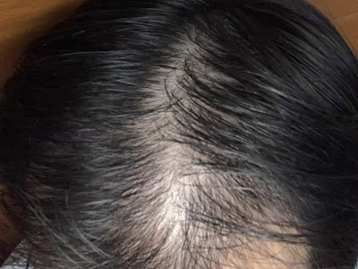 雄激素性脫髮頭髮稀疏密度下降圖 雄激素性脫髮頭髮稀疏密度下降圖