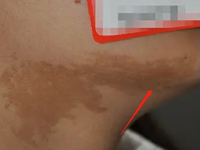 咖啡斑頸部有不規則的深棕色斑圖 咖啡斑頸部有不規則的深棕色斑圖