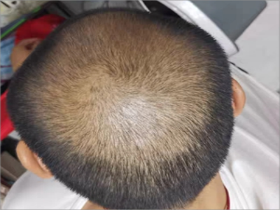 雄激素性脫髮頭頂的頭髮變稀圖 雄激素性脫髮頭頂的頭髮變稀圖