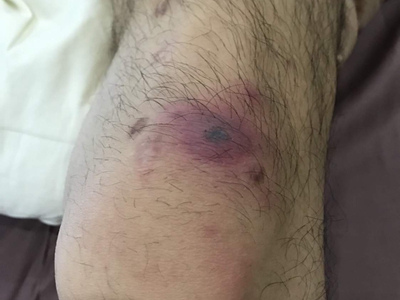 恙蟲病膝蓋上有圓形焦痂圖 恙蟲病膝蓋上有圓形焦痂圖