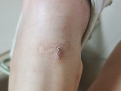 尋常型銀屑病小腿有皮疹圖