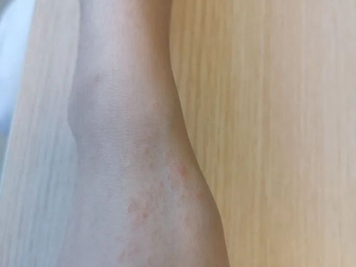 線狀苔蘚手上有淡紅色疹子圖 線狀苔蘚手上有淡紅色疹子圖