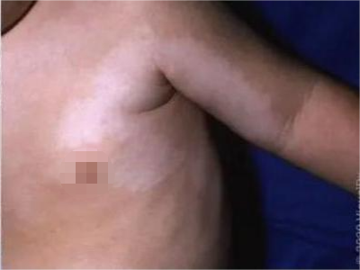 脫色素性痣胸部有大面積白斑圖 脫色素性痣胸部有大面積白斑圖