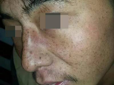 雀斑面部長滿褐色斑點圖