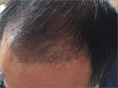 男性型脫髮髮際線上移頭髮稀少圖