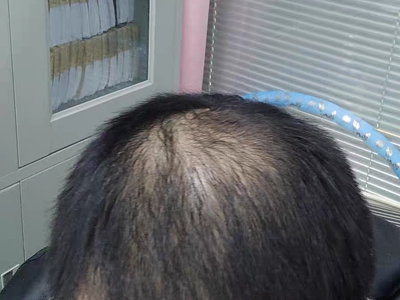 雄激素性脫髮頭頂上脫髮圖