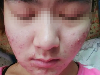 化妝品性痤瘡面部長膿包圖 化妝品性痤瘡面部長膿包圖