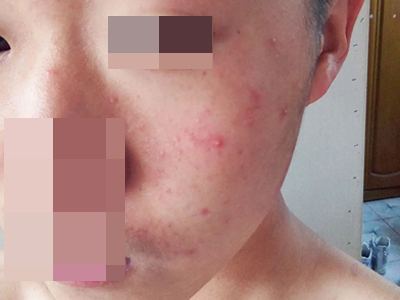 痤瘡的初期症狀圖 痤瘡的初期症狀圖