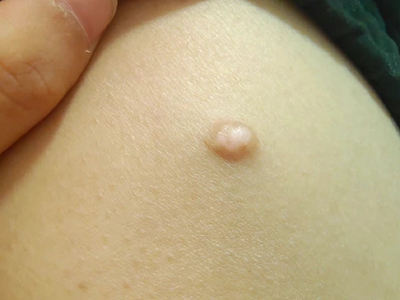 皮脂腺上皮瘤腹部皮色結節圖 皮脂腺上皮瘤腹部皮色結節圖