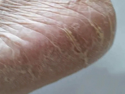 手足皸裂腳後跟起皮有裂紋圖