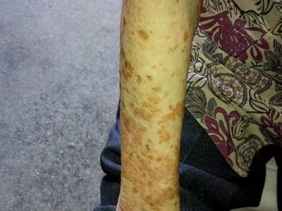尋常型銀屑病胳膊有紅色斑塊圖 尋常型銀屑病胳膊有紅色斑塊圖