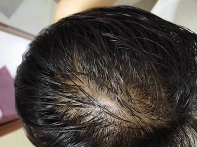 雄激素性脫髮頭髮油膩脫落圖