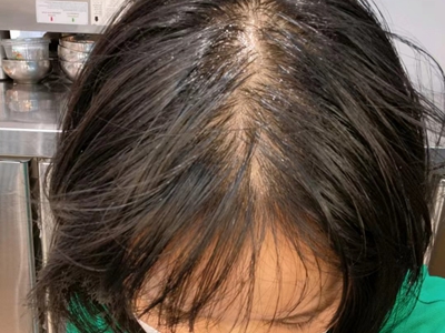 雄激素性脫髮發縫變寬容易出油圖 雄激素性脫髮發縫變寬容易出油圖