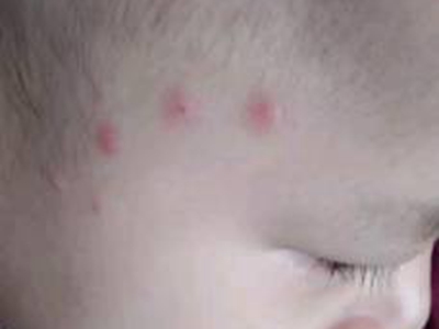 蚊子叮咬寶寶臉上起紅疙瘩圖 蚊子叮咬寶寶臉上起紅疙瘩圖