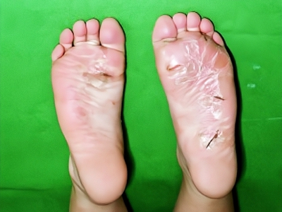 幼年跖部皮病腳底乾燥發亮裂口圖