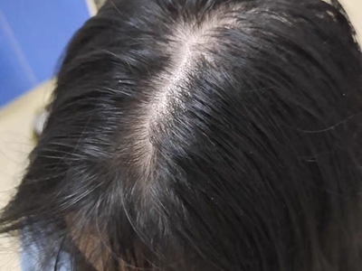 女性型脫髮頭皮中間發縫寬大圖