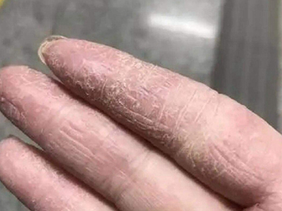手部濕疹手指皮膚乾燥脫屑圖 手部濕疹手指皮膚乾燥脫屑圖