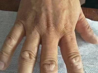 手部濕疹手背起皮圖