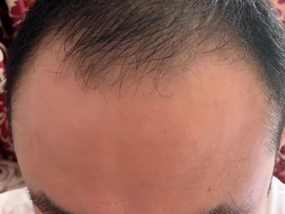 雄激素性脫髮頭頂髮際線後退圖 雄激素性脫髮頭頂髮際線後退圖