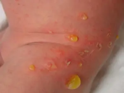 新生兒膿皰瘡的初期圖 新生兒膿皰瘡的初期圖