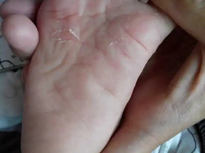 幼年跖部皮病腳底發紅輕微脫皮圖