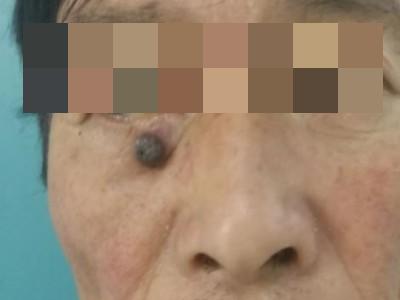 結節型黑色素瘤眼周長圓形結節圖 結節型黑色素瘤眼周長圓形結節圖