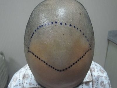 男性型脫髮前額兩側脫髮圖