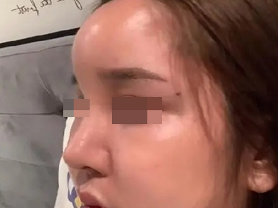 油性肉芽腫額頭出現大包圖 油性肉芽腫額頭出現大包圖