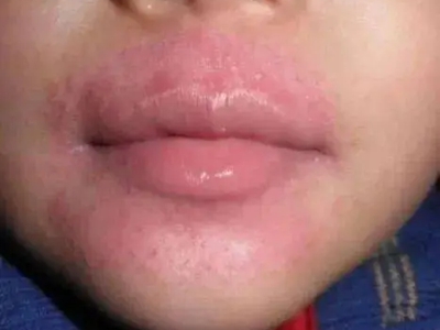 海鮮過敏口周紅斑丘疹圖