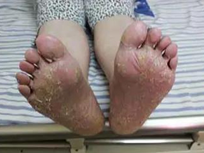 著色真菌病足部大量結痂圖 著色真菌病足部大量結痂圖