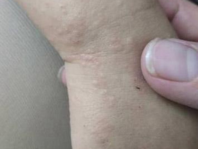 手部濕疹兒童手背很多疙瘩圖 手部濕疹兒童手背很多疙瘩圖