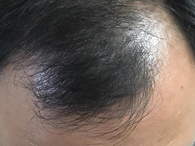 雄激素性脫髮前額兩邊脫髮圖