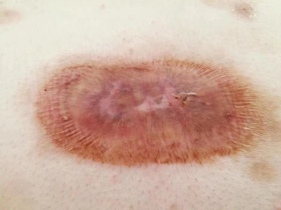 萎縮性瘢痕腹部有一塊褐色瘢痕圖 萎縮性瘢痕腹部有一塊褐色瘢痕圖