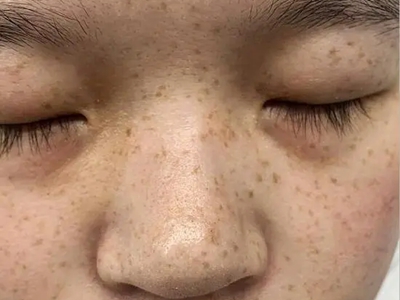 雀斑面部長了很多褐色的小點圖 雀斑面部長了很多褐色的小點圖