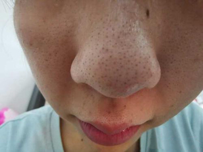 黑頭鼻子上有很多黑點圖 黑頭鼻子上有很多黑點圖