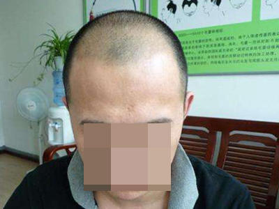 男性型脫髮髮際線升高圖 男性型脫髮髮際線升高圖