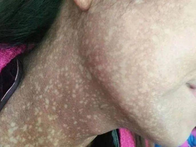 瑞爾黑變病頸部出現大片褐色印圖 瑞爾黑變病頸部出現大片褐色印圖