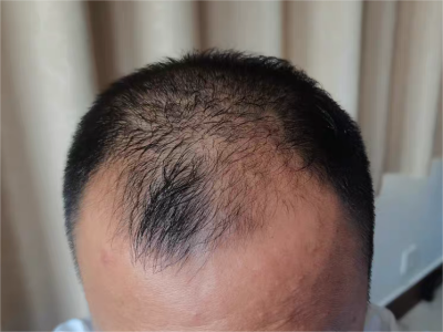 雄激素性脫髮頭部脫髮圖 雄激素性脫髮頭部脫髮圖