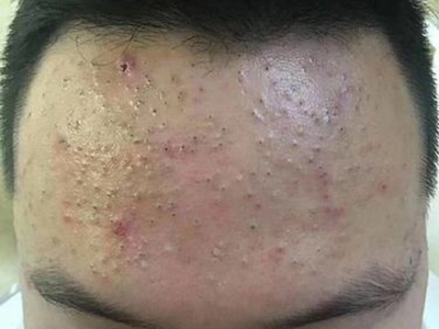 黑頭額頭有黑點皮膚發紅圖
