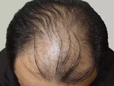 男性型脫髮頭髮大面積稀少脫落圖 男性型脫髮頭髮大面積稀少脫落圖