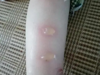蠓蟲叮咬小腿上起大皰圖 蠓蟲叮咬小腿上起大皰圖