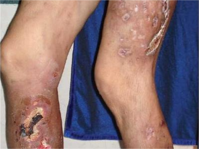 硬結性紅斑腿上壞死性潰瘍圖 硬結性紅斑腿上壞死性潰瘍圖