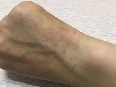 手部濕疹手背很多點狀結痂圖 手部濕疹手背很多點狀結痂圖