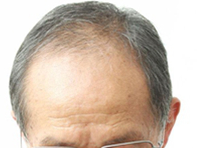 男性型脫髮髮際線後移額頭變寬圖