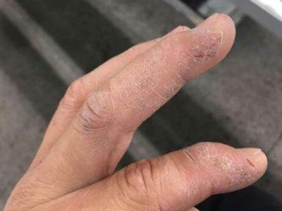 手部濕疹手指皮膚粗糙有裂口圖