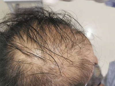 男性型脫髮頭頂頭髮很少圖 男性型脫髮頭頂頭髮很少圖