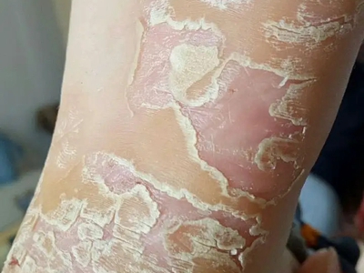 手足皸裂腳底脫皮圖 手足皸裂腳底脫皮圖