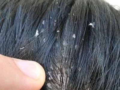頭皮糠疹頭上很多皮屑圖 頭皮糠疹頭上很多皮屑圖