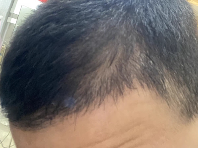 雄激素性脫髮前額角頭髮稀少圖